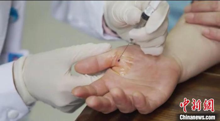 嘉善群眾體驗(yàn)小針刀?！〖紊平y(tǒng)戰(zhàn) 供圖