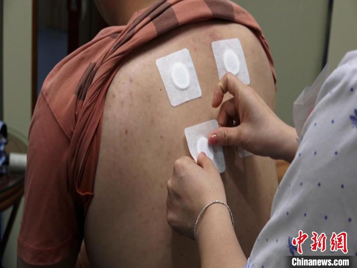 圖為醫(yī)生正在為民眾貼“三伏貼”?！√莆登?攝